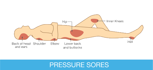 a diagrom showing where you can suffer pressure sores