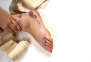 Foot injury compensation