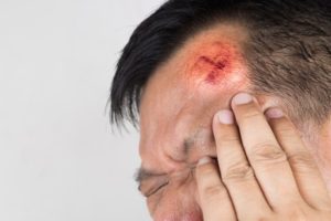 Head injury claims