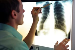 Rib injury compensation claims