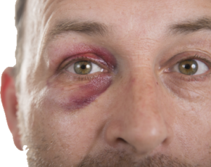 Eye injury compensation claim