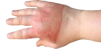 Cut Finger Tendon Compensation Pasadena thumbnail