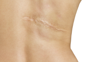 Permanent scar compensation
