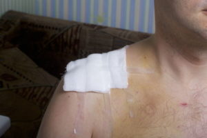 Broken collarbone injury