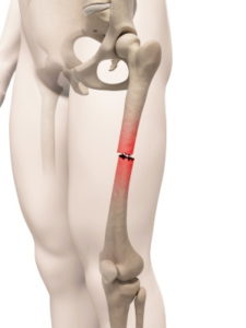 Broken femur injury