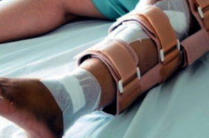 Broken fibula injury