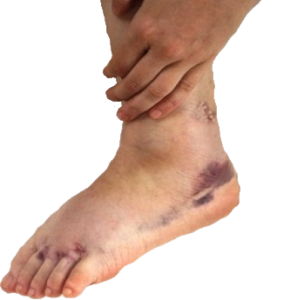 Broken heel injury claims