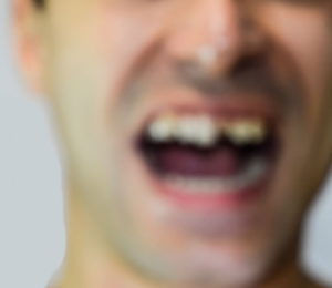 Broken tooth injury