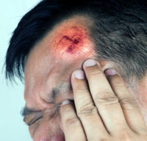 A man with a concussion injury holding the left side of their head in pain