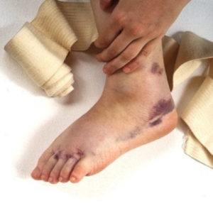 Sprained ankle compensation