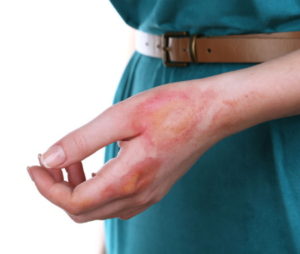 A woman's hand with multiple burn injuries