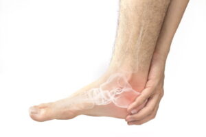 Avulsion fracture personal injury claims guide