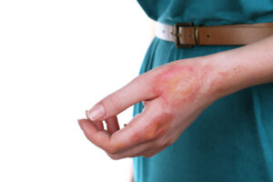 A woman's left hand with scarring from a chemical burn injury