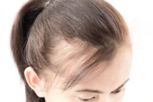 Close Up Of A Woman's Hair Loss. 