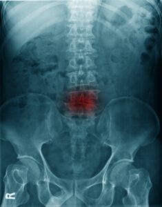 An x-ray of a lumbar fracture.