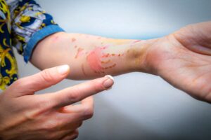 A person holding out a burned and blistered arm.