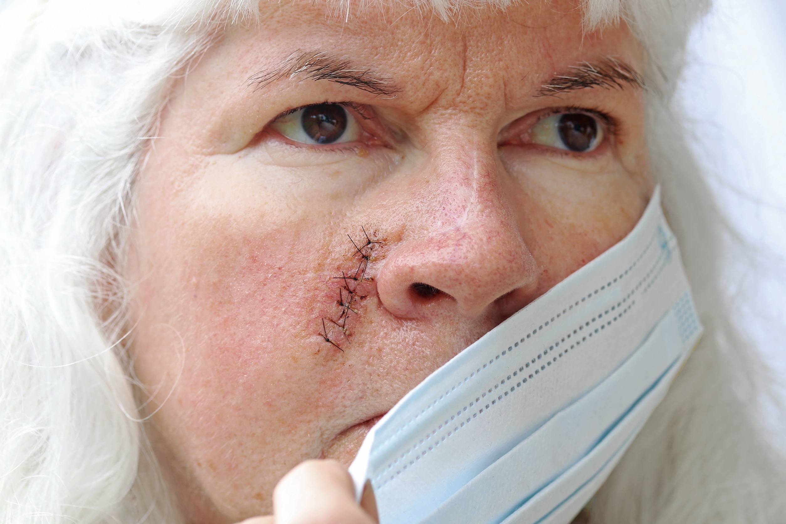 Woman With Stitches On Her Face That Will Cause A Scarring Injury. 