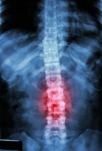 An X-ray of a spinal injury.