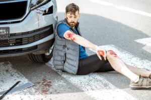 A pedestrian looking at an elbow injury suffered in a zebra crossing accident.