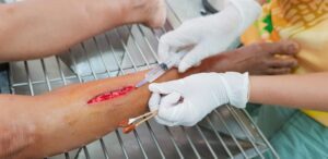HOSPITAL STAFF TREATING PERSON WITH SEVERE SOFT TISSUE INJURIES ON THEIR LEG