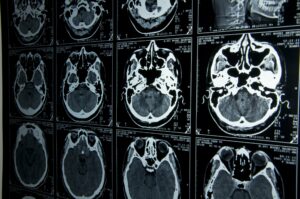 MRI SCANS OF BRAIN INJURIES
