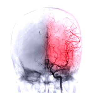 SCAN OF A SERIOUS TRAUMATIC BRAIN INJURY 