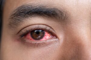 A close-up image of a person's reddened and inflamed eye.