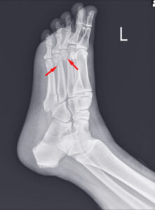 X-RAY OF A FRACTURED ANKLE