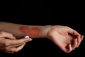 A woman has a serious burn injury on the inside of her arm.