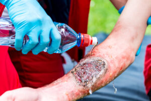 A person has full thickness burns which require medical treatment. 