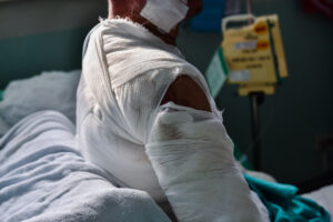 A person has had deep dermal burns and is left with life changing burn injuries.