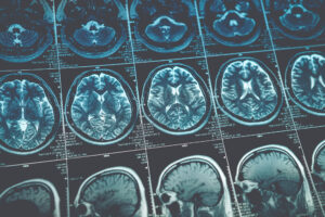 SEQUENCE OF MRI BRAIN CANCER SCANS